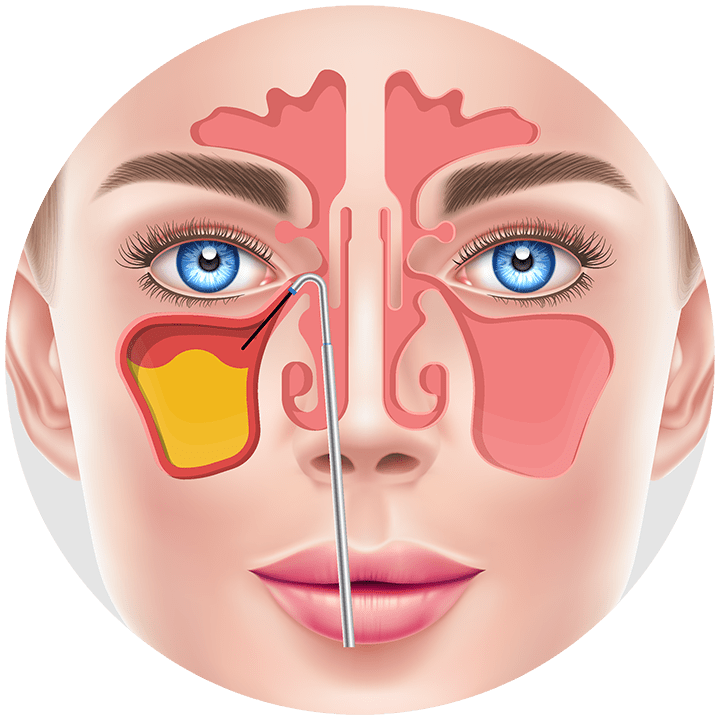 Sinus Congestion Diagram