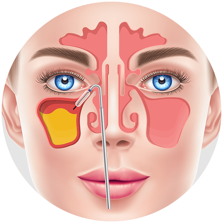 Sinus illustration 2